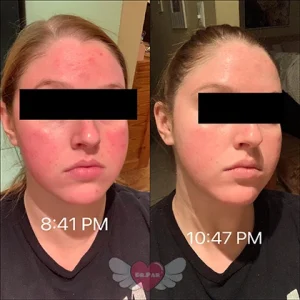 ویژگی های ژل سیکاپلاست لاروش پوزای ترمیم کننده