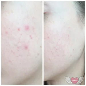 تاثیرکرم سیکاپلاست لاروش پوزای