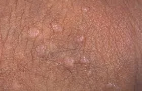 زگیل تناسلی در زنان