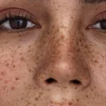 کک و مک: تعریف، انواع، علل و راهکارهای درمانی