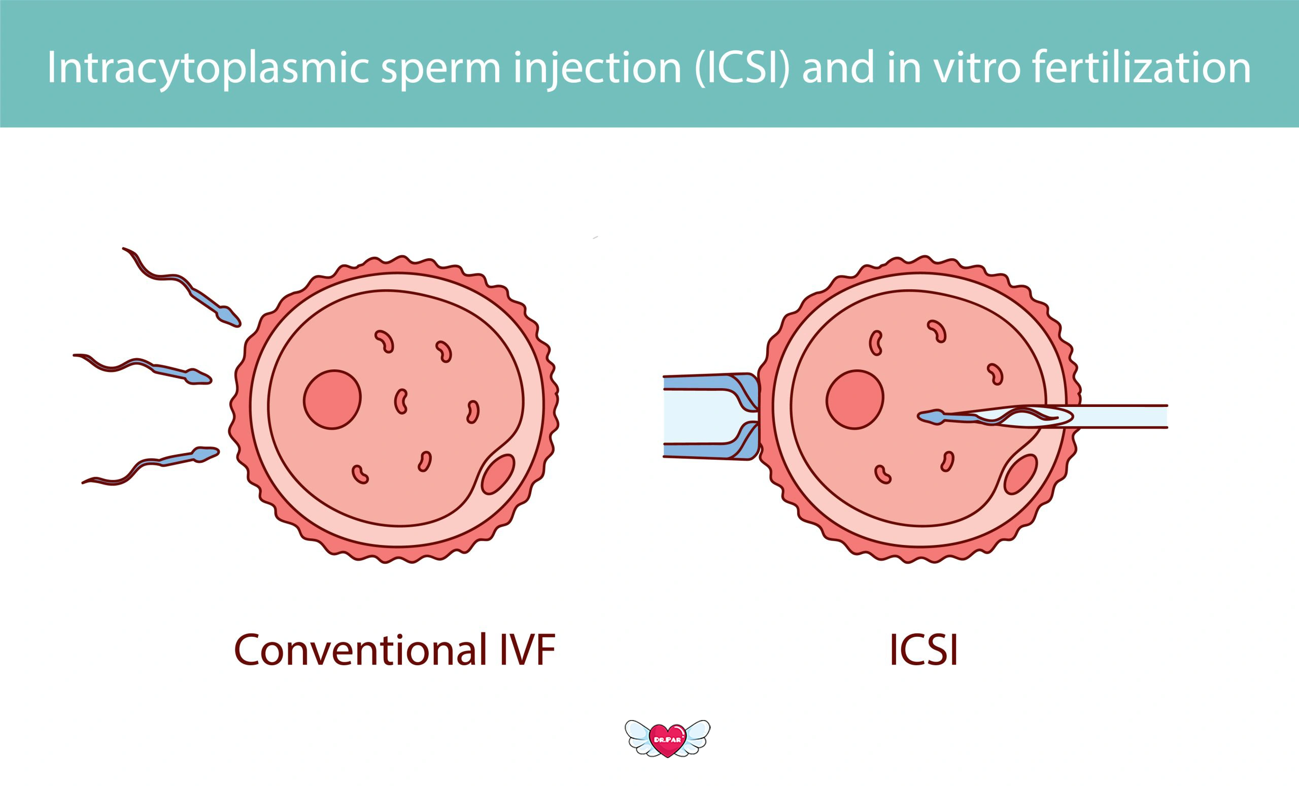 IVF چیست؟ راهکاری پیشرفته برای درمان ناباروری