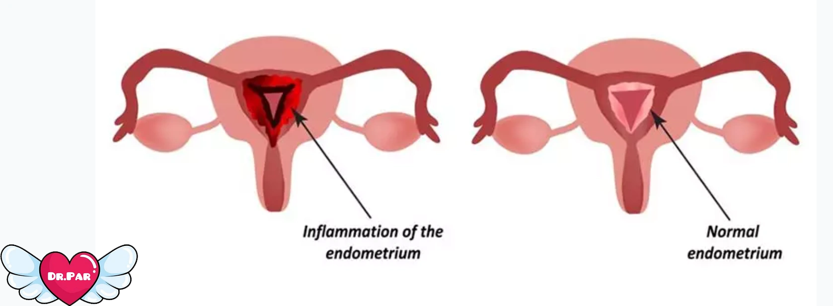 وقتی رحم دچار التهاب می‌شود: همه چیز درباره اندومتریت