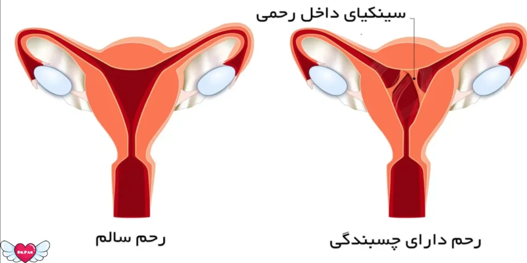 وقتی رحم قفل می‌شود: چسبندگی رحم یا سندروم آشرمن چیست؟