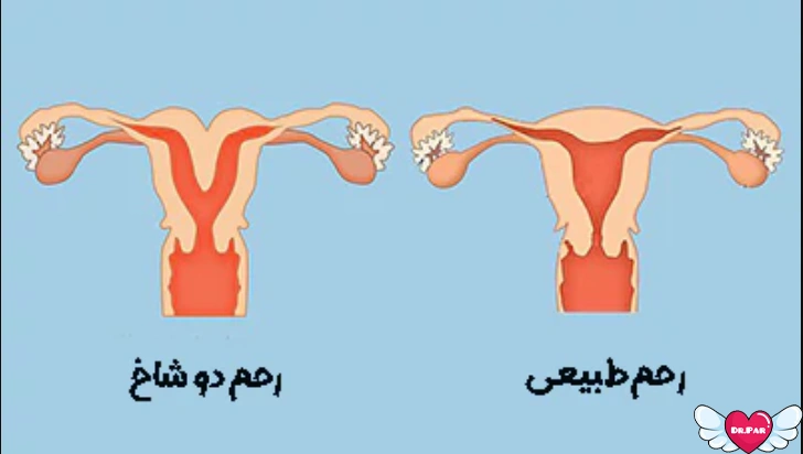 رحم دوشاخ؛ راز نادر در ساختار رحم زنان!