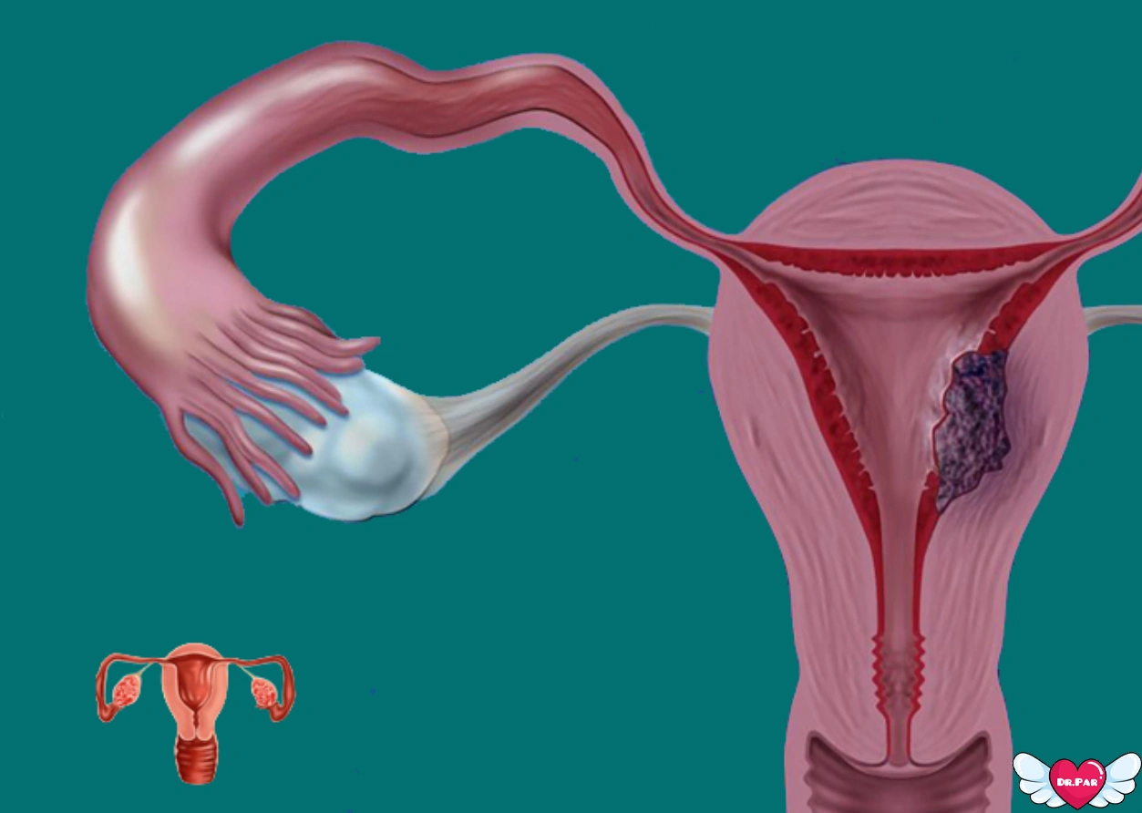 وقتی آندومتر به تهدید تبدیل می‌شود: نگاهی دقیق به سرطان رحم