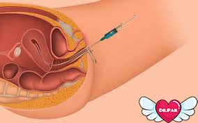 IUI چیست؟ روشی ساده و مؤثر برای درمان ناباروری