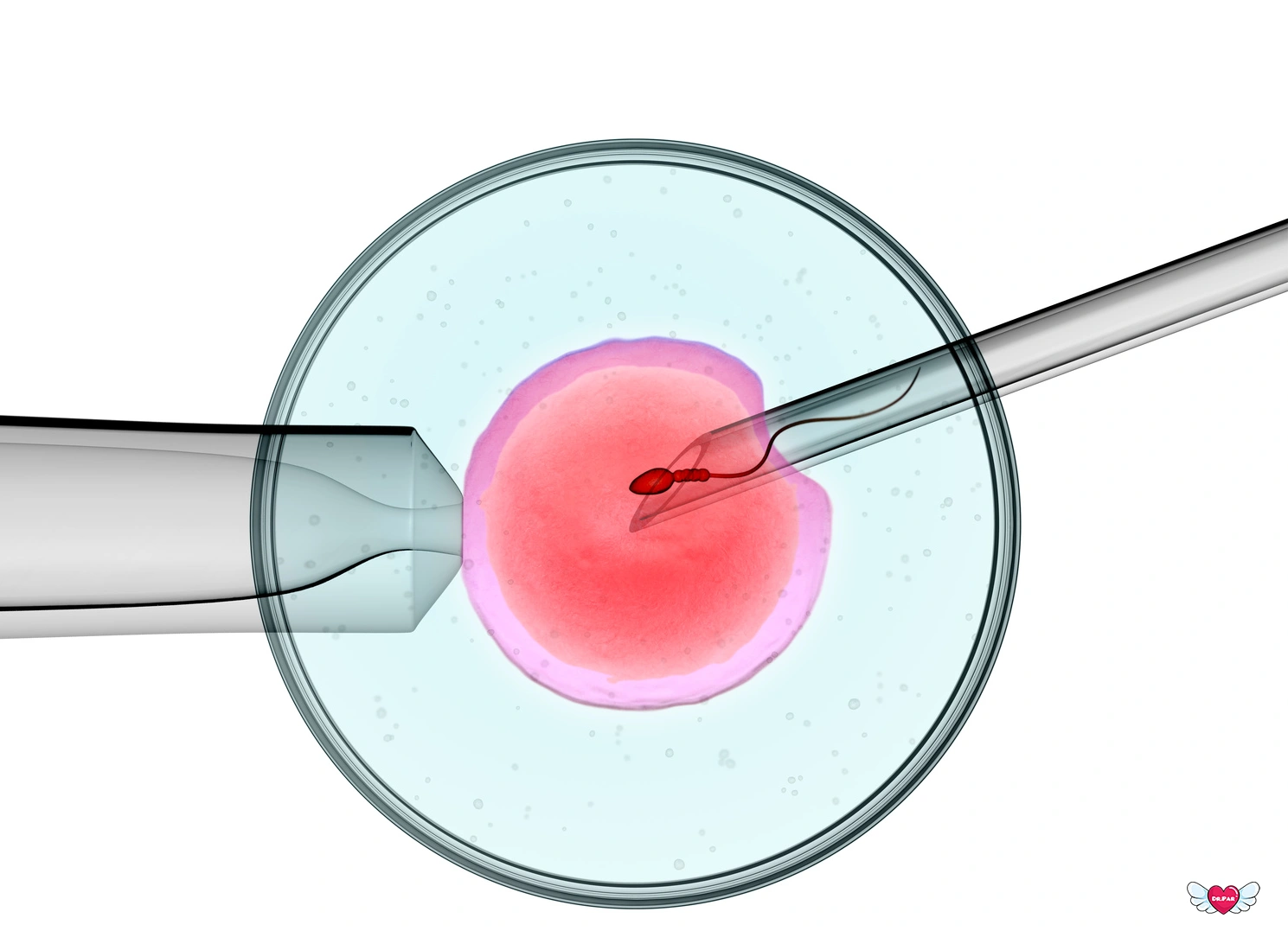 ICSI چیست؟ روش تزریق اسپرم به داخل تخمک در درمان ناباروری
