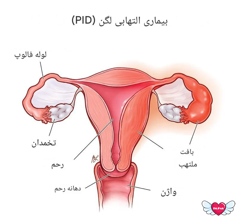 عفونت‌های لگنی: تهدیدی شایع و قابل پیشگیری برای سلامت زنان