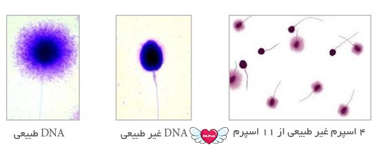 روش SDF شکستگی DNA اسپرم چیست؟