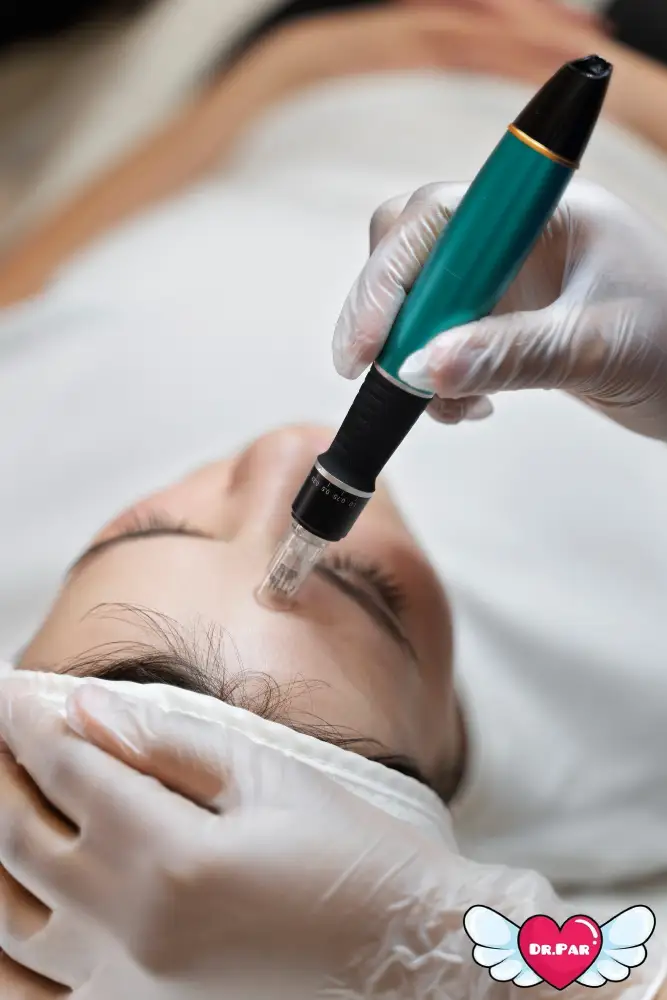 میکرونیدلینگ صورت برای جای جوش