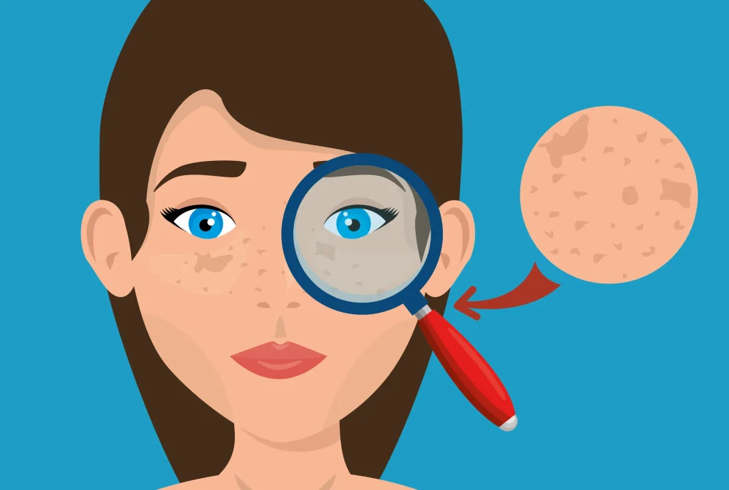 جوش زیر پوستی