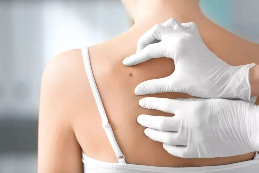 انواع سرطان پوست