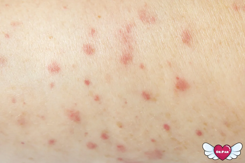 دلایل بروز جوش بدن