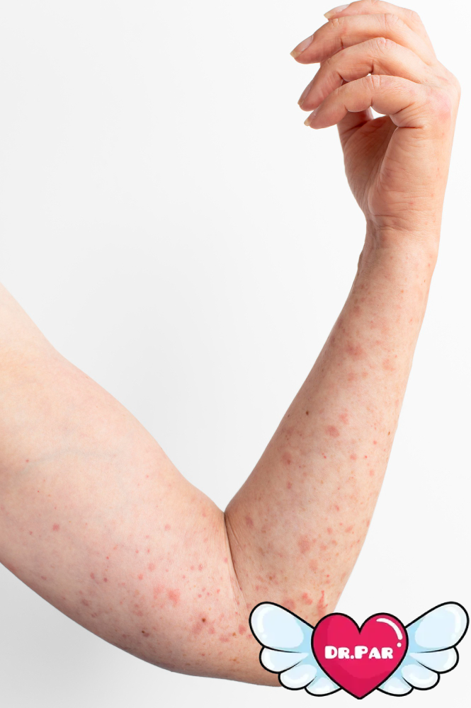 کهیر مزمن چیست