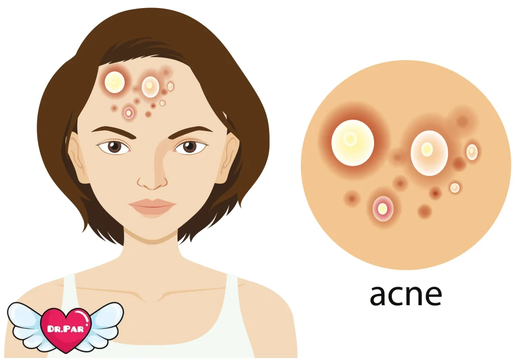آکنه هورمونی و ویژگیهای آن