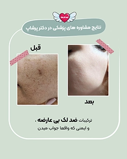 قبل و بعد از درمان هایپرپیگمنتیشن