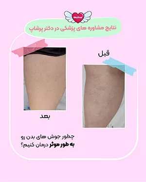 نتایج مشاوره پزشکی دکتر پرشاپ رفع جوش