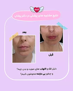 نتایج مشاوره پزشکی دکتر پرشاپ رفع التهاب