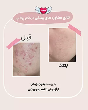 نتایج مشاوره پزشکی دکتر پرشاپ رفع جوش